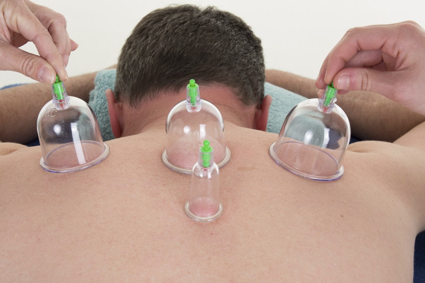 Dry Cupping Therapy